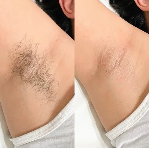 Underarm waxing close-up